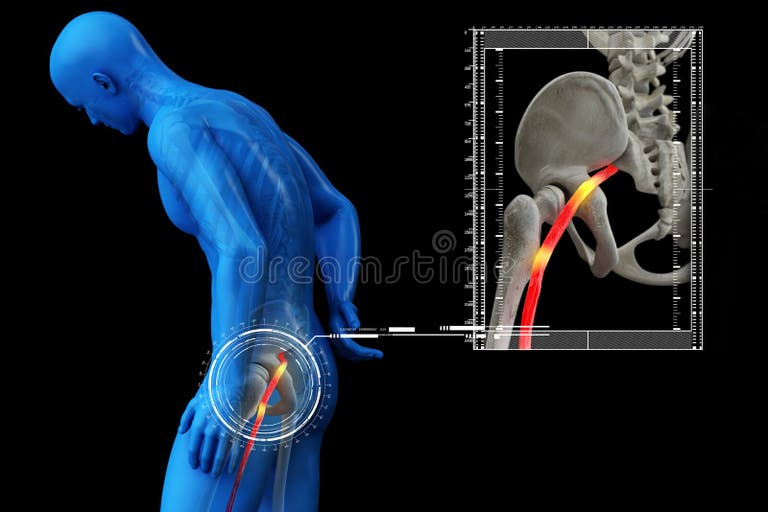 Leg Numbness Stock Illustrations – 134 Leg Numbness Stock Illustrations ...