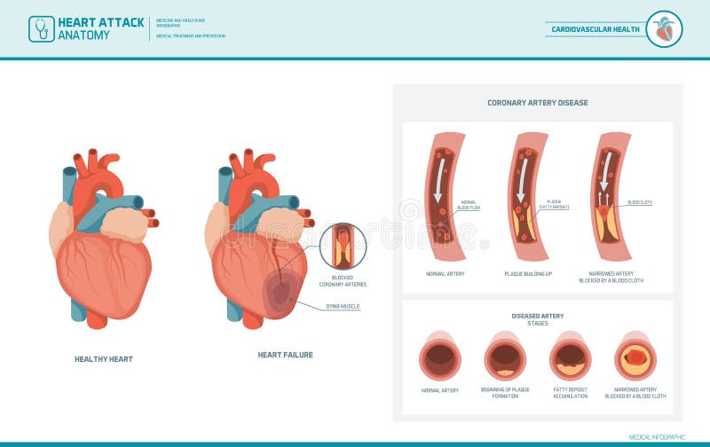 Anatomie van een hartaanval