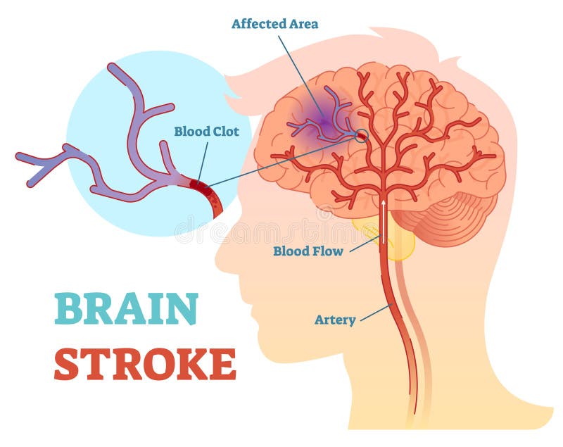 Anatomisch vector de illustratiediagram van Brain Stroke, regeling