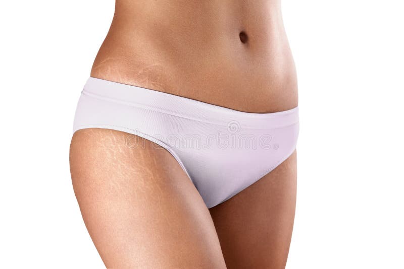 Anche femminili con le smagliature fotografie stock Anche femminili con le smagliature fotografie stock