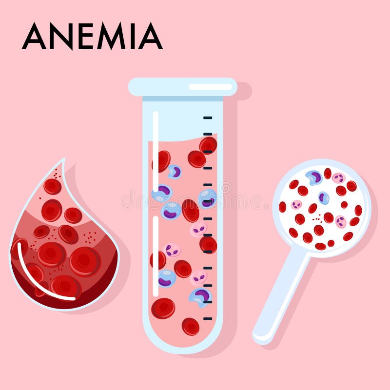 Anemia Concept.Glass Laboratory Test Tube and Magnifier with Blood