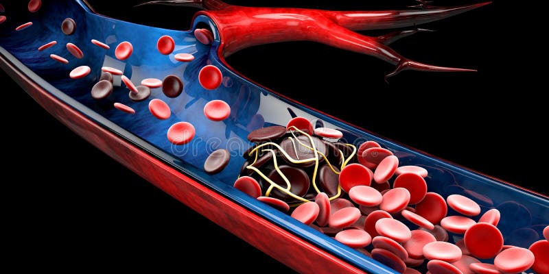 Anemia De La Célula Falciforme Mostrando El Vaso Sanguíneo Con El