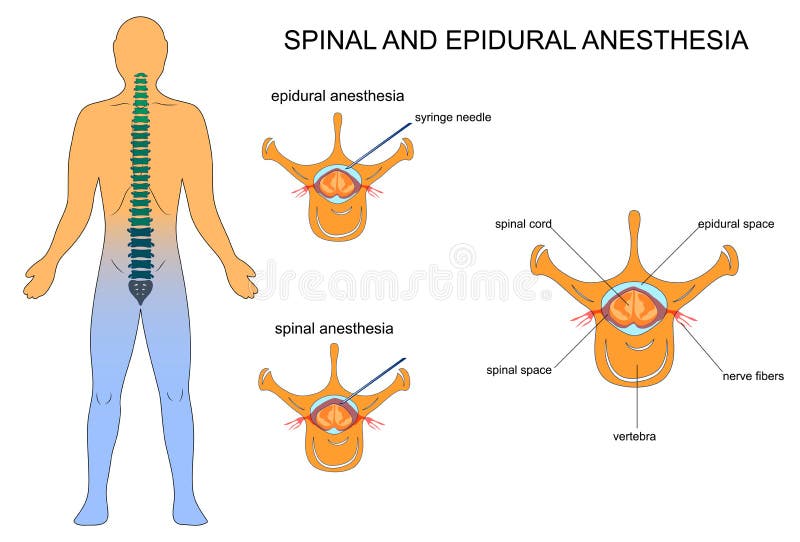 Vector illustration of epidural and spinal anaesthesia. Vector illustration of epidural and spinal anaesthesia