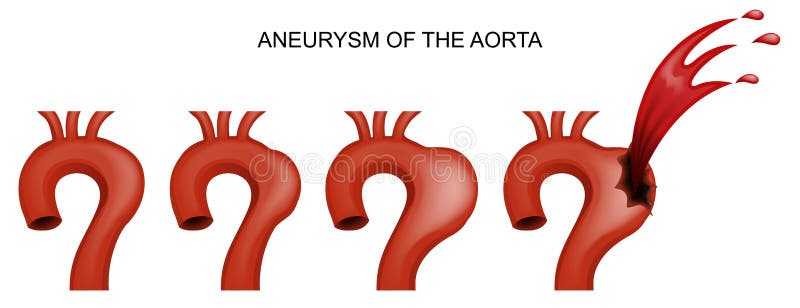 Aneurisma da aorta cardiology ilustração royalty free Aneurisma da aorta cardiology ilustração royalty free
