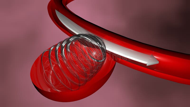 Aneurisma, endovascular behandeling royalty-vrije illustratie Aneurisma, endovascular behandeling royalty-vrije illustratie