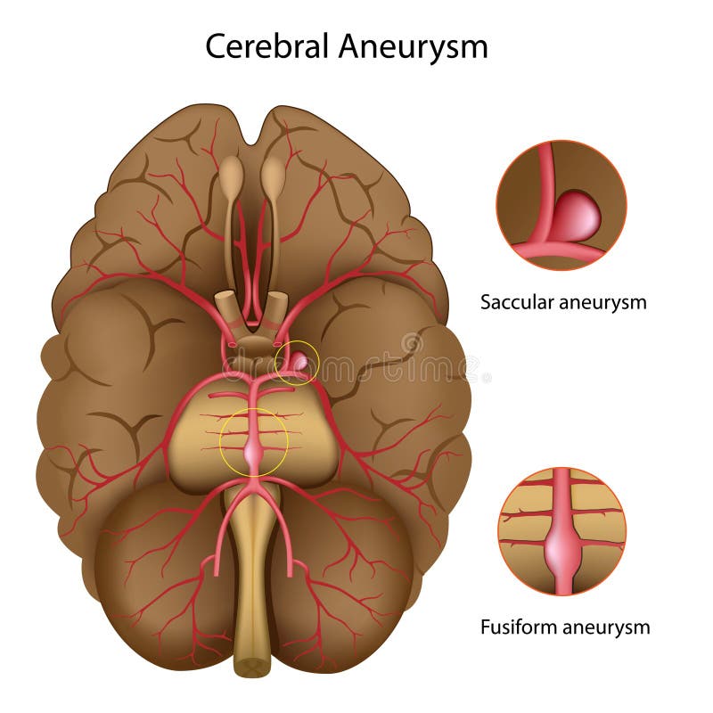 Aneurysm cérébral illustration libre de droits Aneurysm cérébral illustration libre de droits