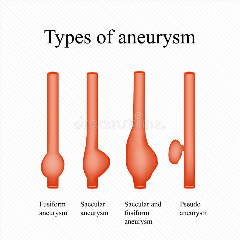 aneurysm Pisać na maszynie aneurysm Infographics również zwrócić corel ilustracji wektora ilustracji aneurysm Pisać na maszynie aneurysm Infographics również zwrócić corel ilustracji wektora ilustracji