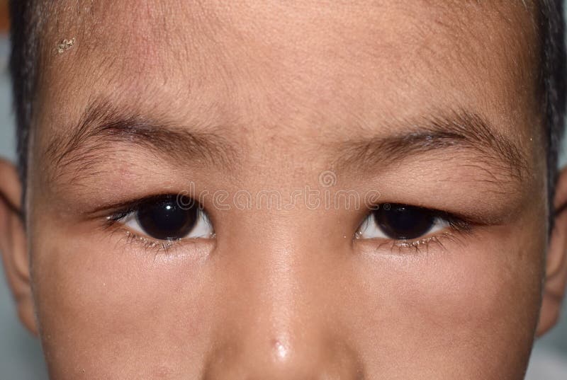 Angioedema At Eyelids And Lips Of Asian Male Child Puffy Face