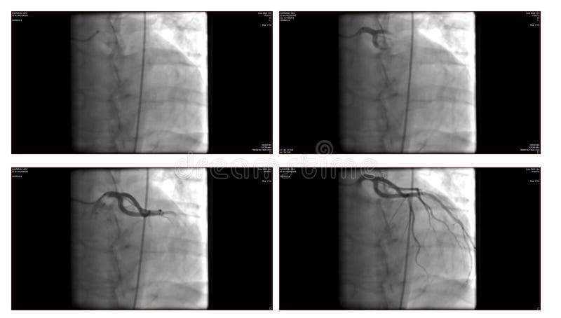 Angiogram zdjęcie royalty free Angiogram zdjęcie royalty free