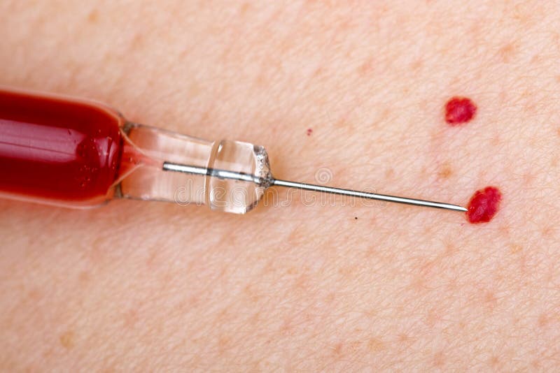 Angioma Della Ciliegia Su Pelle Umana Fotografia Stock Immagine di