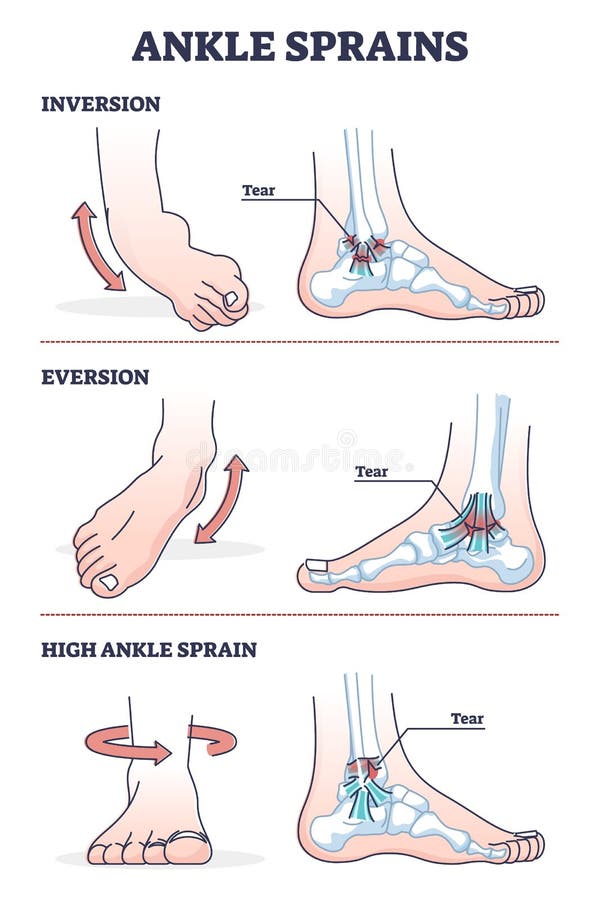 everted leg varicose