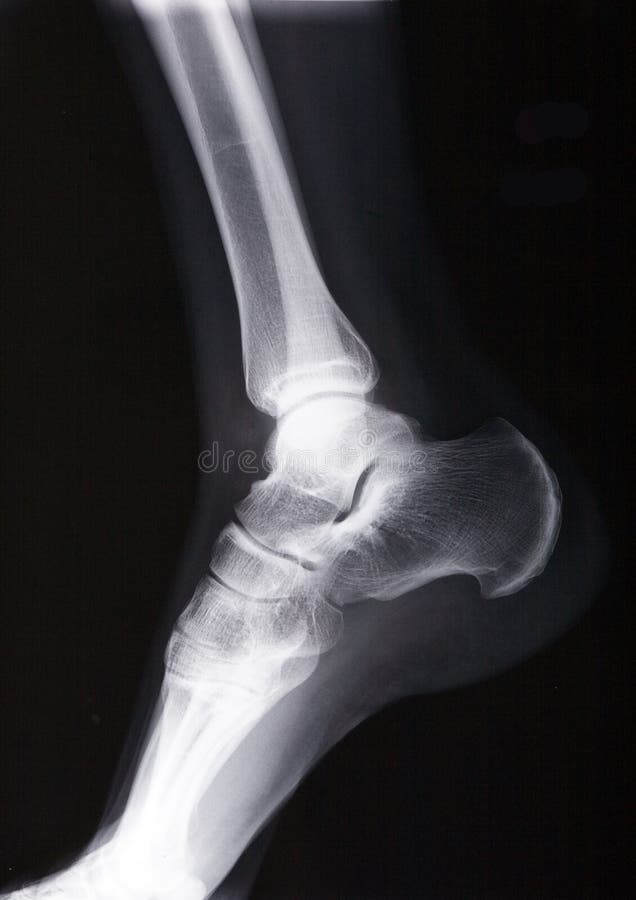 Ankle xray