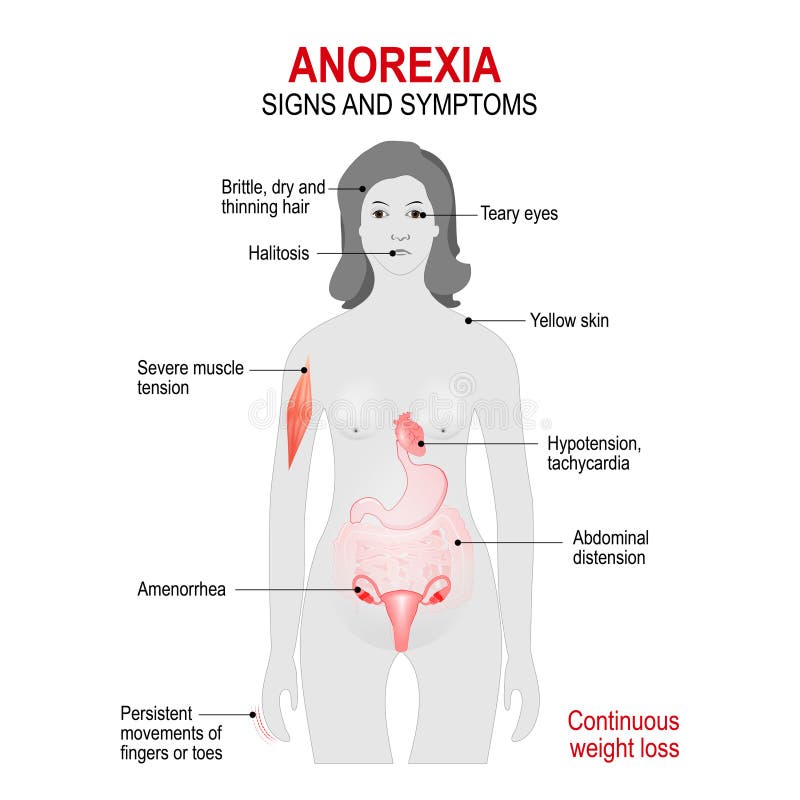 anorexia nervosa kennzeichen