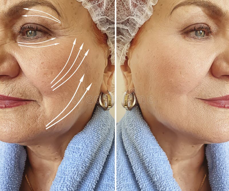 Face old woman wrinkles before and after treatment, arrow, thread lifting problem. Face old woman wrinkles before and after treatment, arrow, thread lifting problem