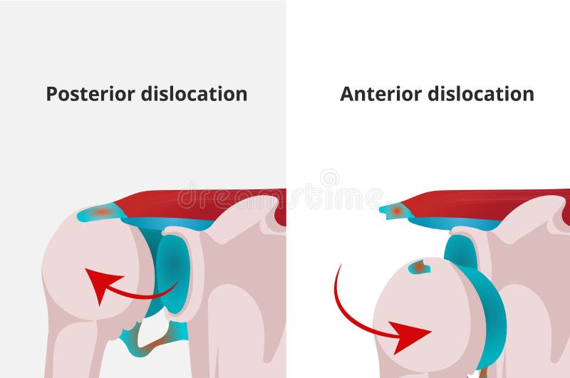 Shoulder Dislocation Stock Illustrations – 155 Shoulder Dislocation Stock  Illustrations, Vectors & Clipart - Dreamstime