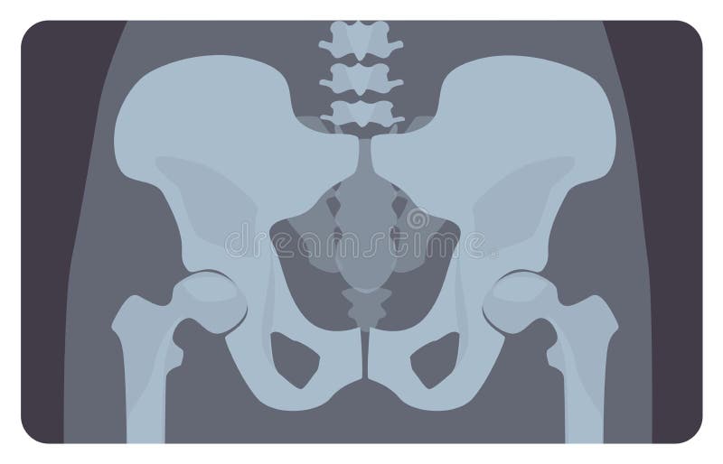 Anterior radiograph ludzka pelvis lub biodra kość z dolędźwiową częścią Radiologiczny obrazek lub wizerunek ludzki kośćcowy syste royalty ilustracja Anterior radiograph ludzka pelvis lub biodra kość z dolędźwiową częścią Radiologiczny obrazek lub wizerunek ludzki kośćcowy syste royalty ilustracja
