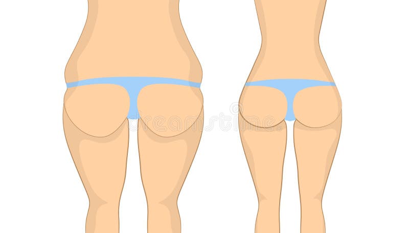 Antes y después de las nalgas ilustración del vector Antes y después de las nalgas ilustración del vector