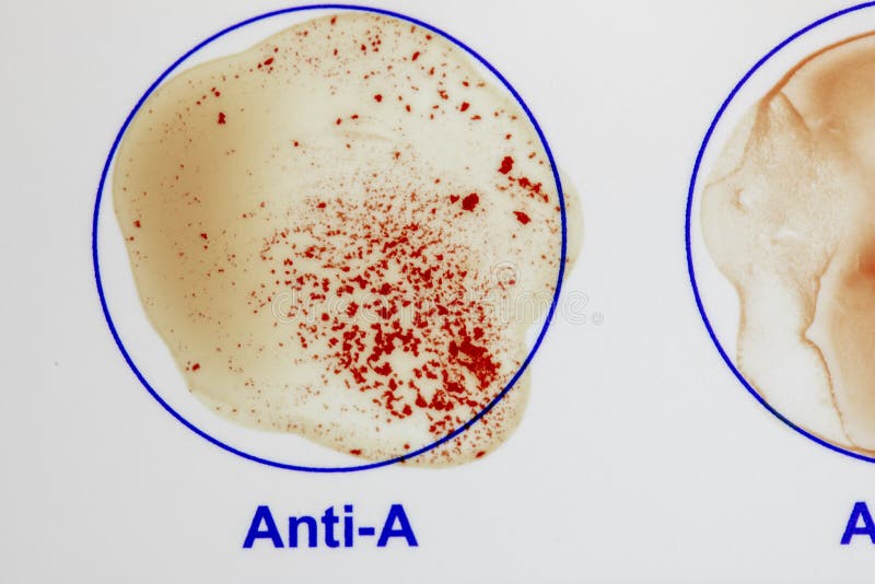 Antibody a Blood Agent Test Stock Image Image of typing, result