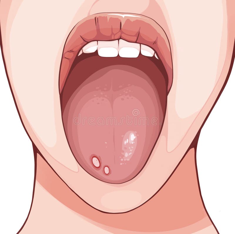 An aphthous ulcer is typically a recurrent round or oval sore or ulcer inside the mouth