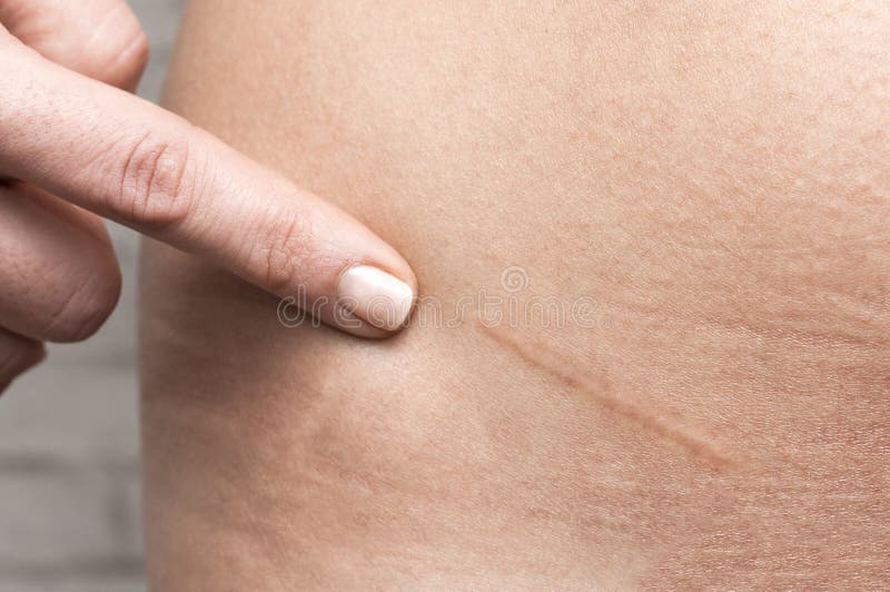 normal appendicitis scar