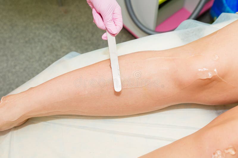 Application of Contact Gel before Laser Hair Removal Procedure. Preparation  of the Skin Surface for Laser Hair Removal. Stock Image - Image of  dermatology, medical: 137566109