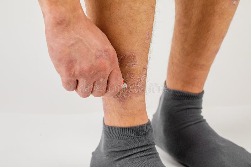 Application of Therapeutic Ointment for Allergic Rashes on the Leg