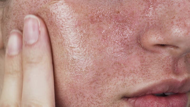 Appliquer la crème sur le visage brûlé femme fermer clips vidéos