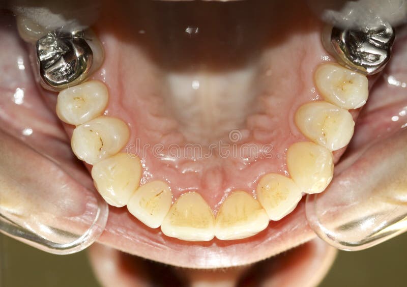 Divaricatore Per Labbra Intraorale Ortodontico Dentale - Foto 14
