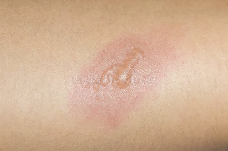 Burn blister stock photo. Image of toes, hurt, skin, burn 38708260