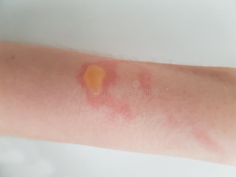 Burn blister stock photo. Image of hurt, skin, blister 38708260