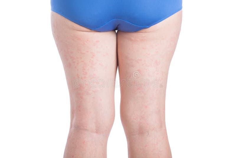 Arrière de jambe de femme avec l'éruption d'allergie au-dessus du blanc images stock Arrière de jambe de femme avec l'éruption d'allergie au-dessus du blanc images stock