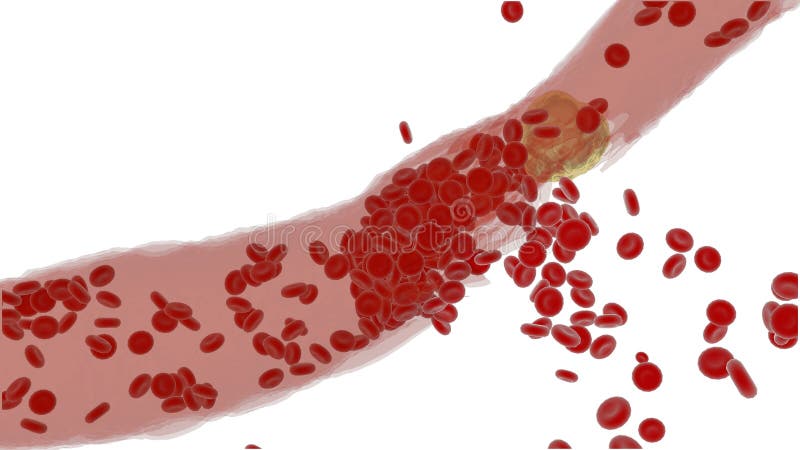 Arteria ostruita con le piastrine e la placca del colesterolo, concetto per il rischio sanitario per obesità royalty illustrazione gratis Arteria ostruita con le piastrine e la placca del colesterolo, concetto per il rischio sanitario per obesità royalty illustrazione gratis