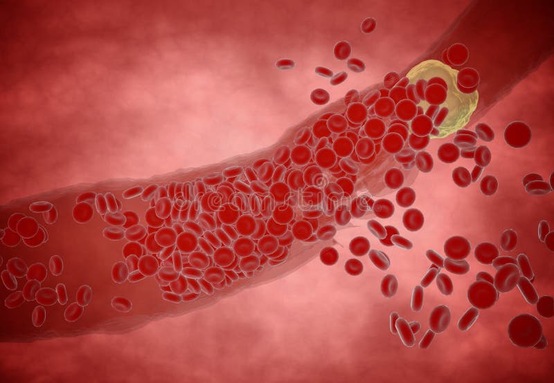 Clogged Artery with platelets and cholesterol plaque, concept for health risk for obesity or dieting and nutrition problems. Clogged Artery with platelets and cholesterol plaque, concept for health risk for obesity or dieting and nutrition problems.