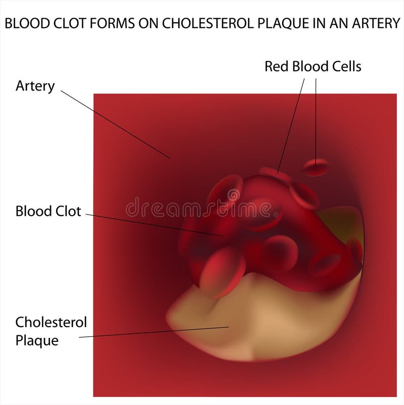 Arterii krwionośnego cholesterolu zakrzepu target1276_0_ plakieta