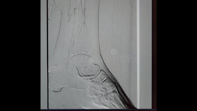 Arteriograma da perna esquerda com articulação do tornozelo