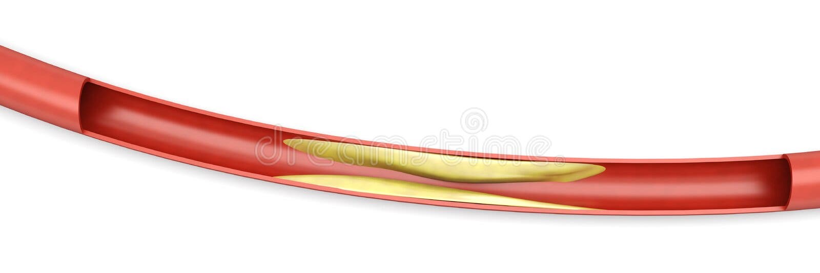 Arteriosclerosis stock illustration