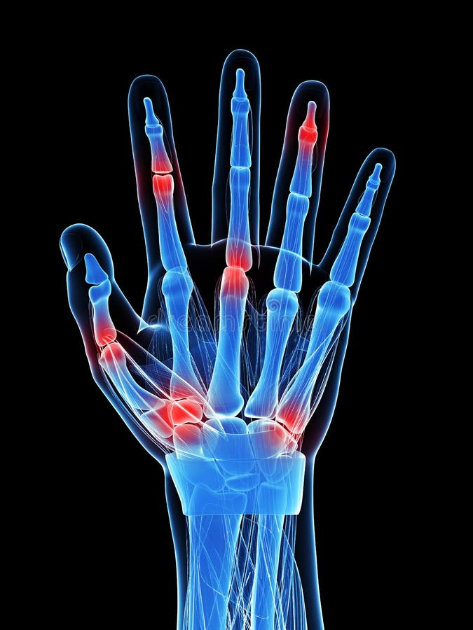 Painful finger joints stock illustration. Illustration of fingers