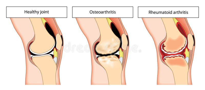 Arthritic knee joint stock illustration. Illustration of osteoarthritis -  77240898