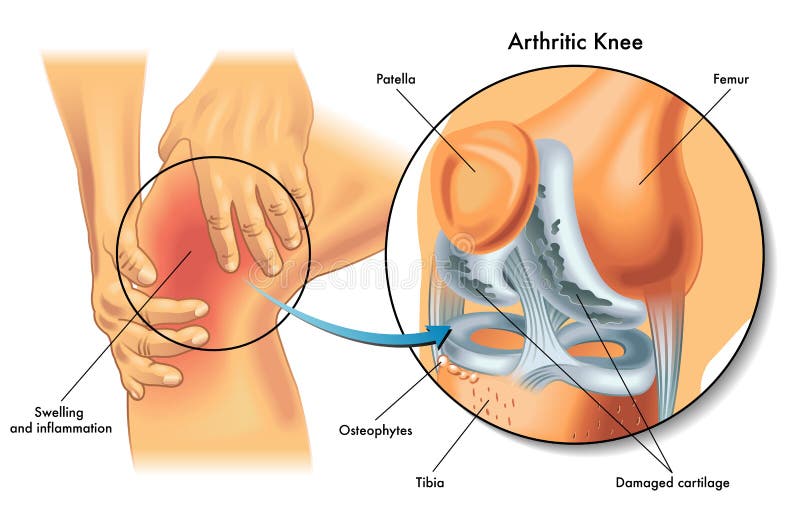 Illustrazione medica dei sintomi di artrite al ginocchio.
