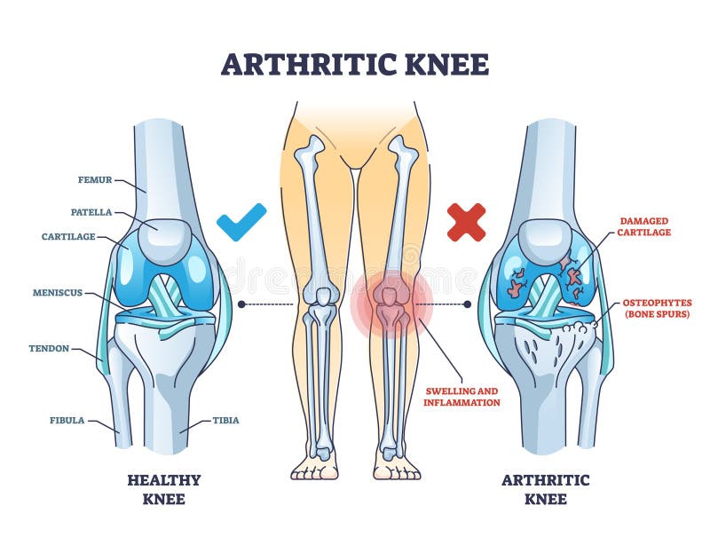 Arthritic Knee or Osteoarthritis and Healthy Bones Comparison Outline ...
