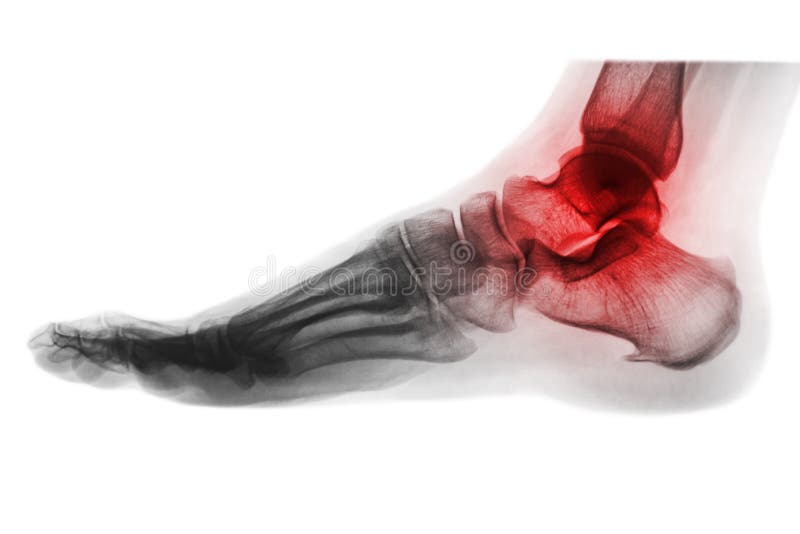 Arthritis of ankle . X-ray of foot . Lateral view . Invert color style