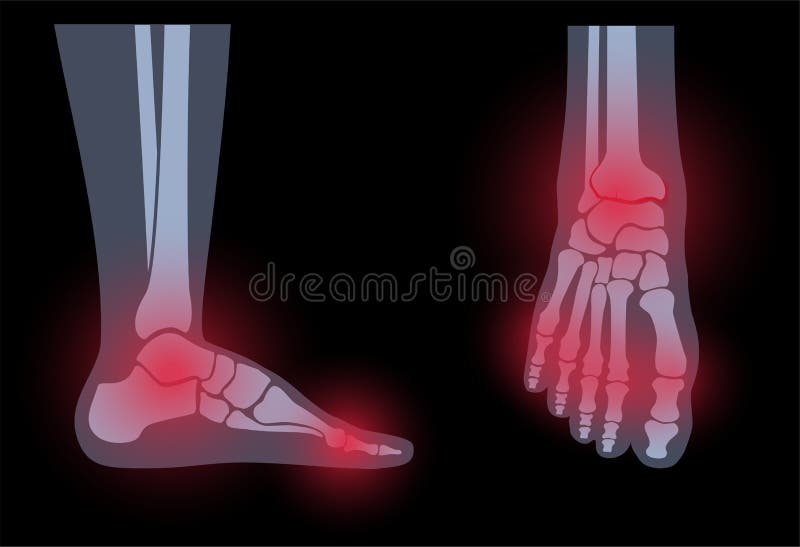 Flank Pain Stock Illustrations – 34 Flank Pain Stock Illustrations, Vectors  & Clipart - Dreamstime