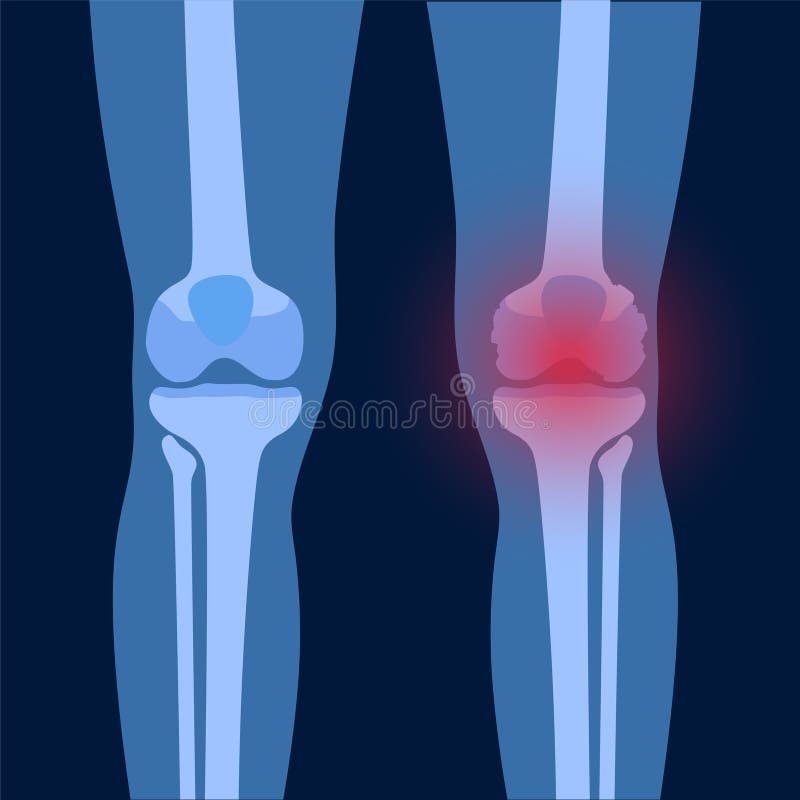 Normal Joint Rheumatoid Arthritis Stock Illustrations – 262 Normal ...