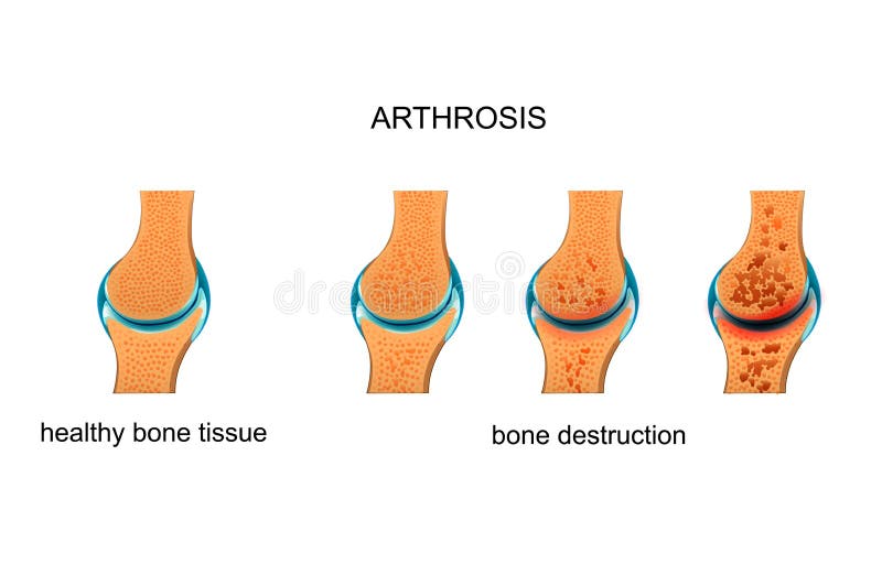 metatarsalis arthrosis