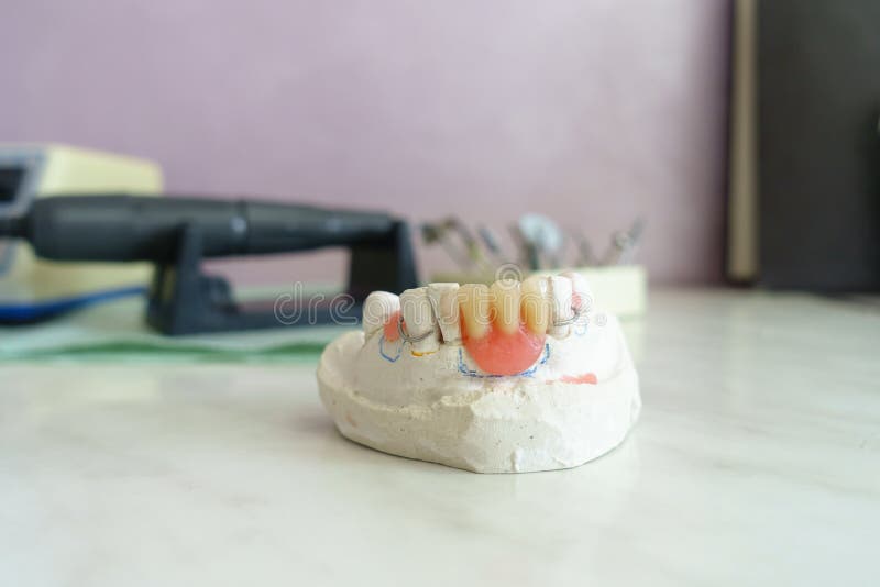 Artificial Removable Dental Prosthesis Stock Photo Image of teeth