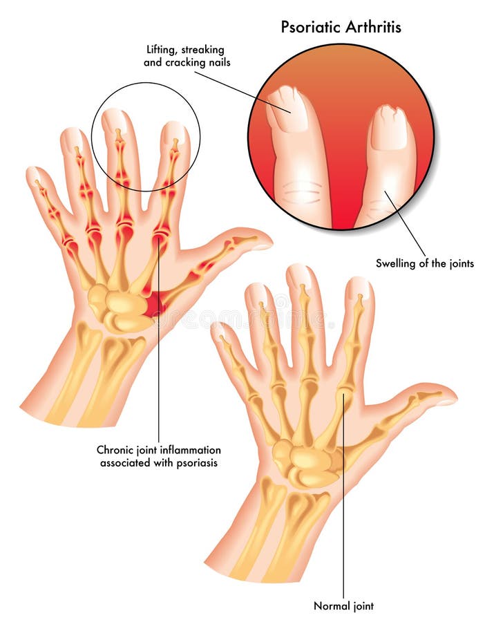 Artrite psoriasica illustrazione di stock Artrite psoriasica illustrazione di stock