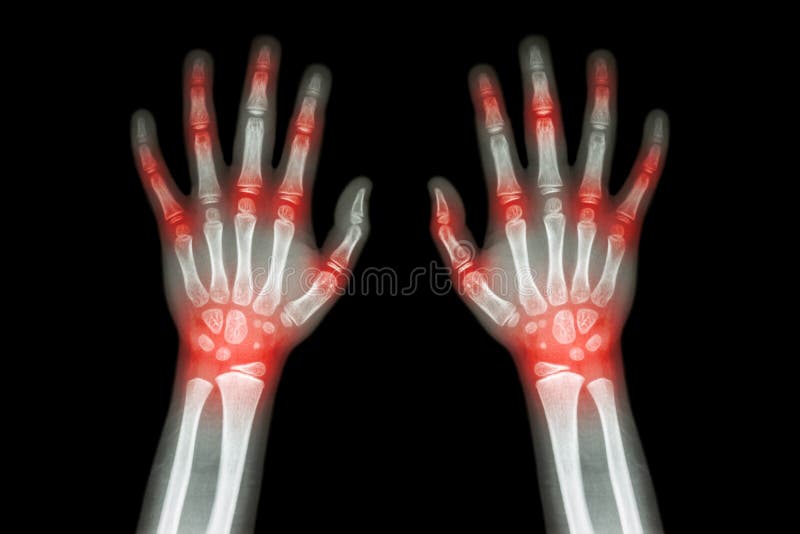 Artrite reumatoide, artrite di gotta (raggi x del film entrambe le mani del bambino con l'artrite unita multipla) (medica, scienz