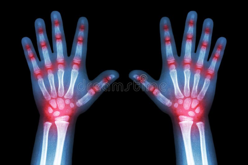 Artrite reumatoide (faccia i raggi x sia delle mani del bambino che dell'artrite unita multipla)