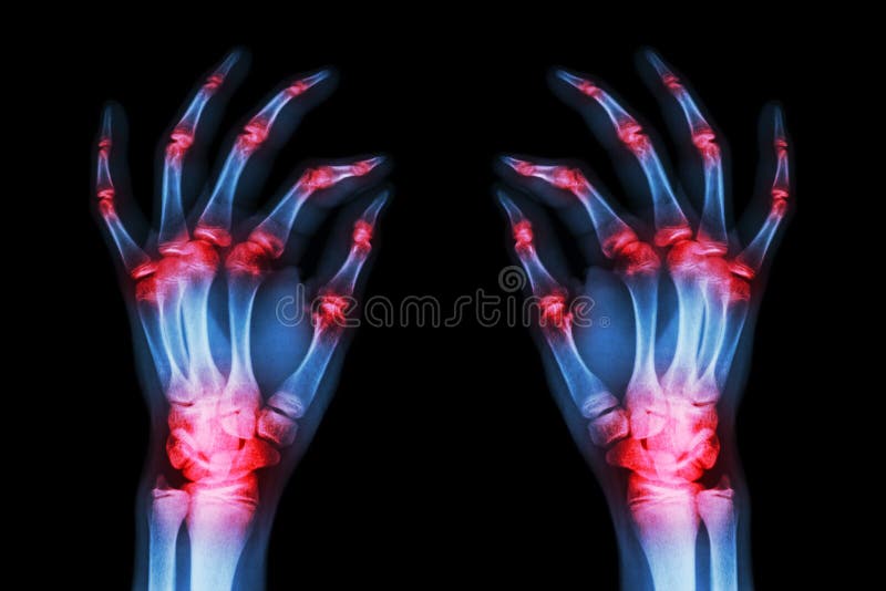 Artrite unita multipla entrambe le mani dell'adulto (gotta, reumatoidi) su fondo nero