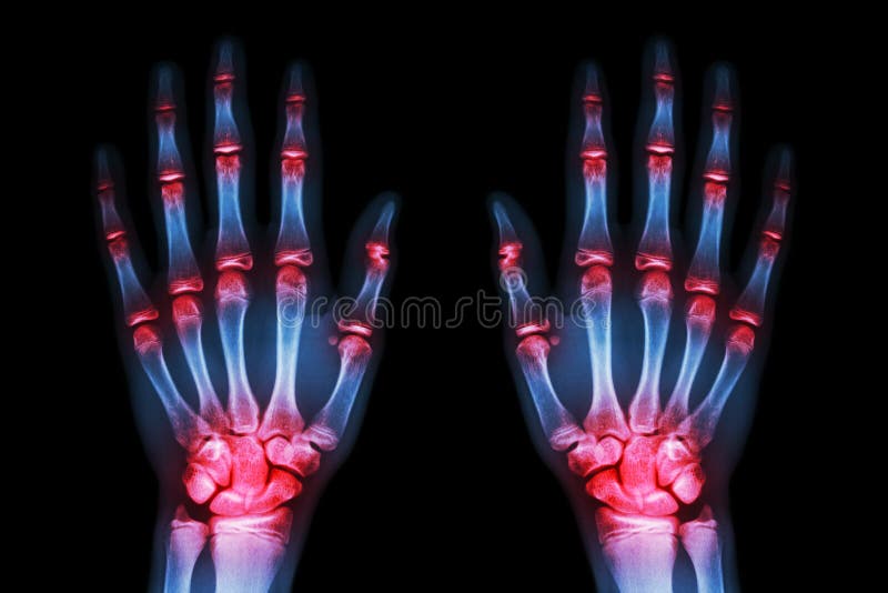 Artrite unita multipla entrambe le mani (gotta, reumatoidi) su fondo nero